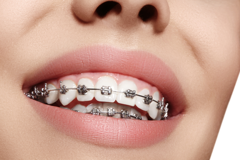 orthodontics treatment Mississauga
