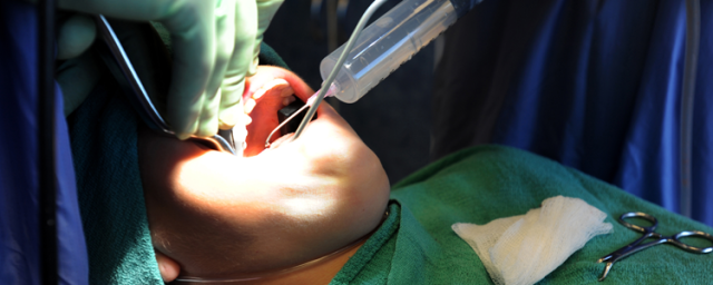 tooth extraction mississauga